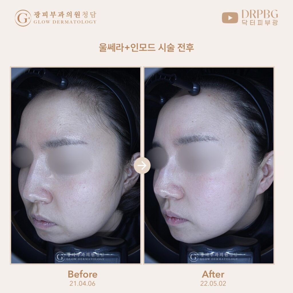 청담 광피부과청담 리프팅