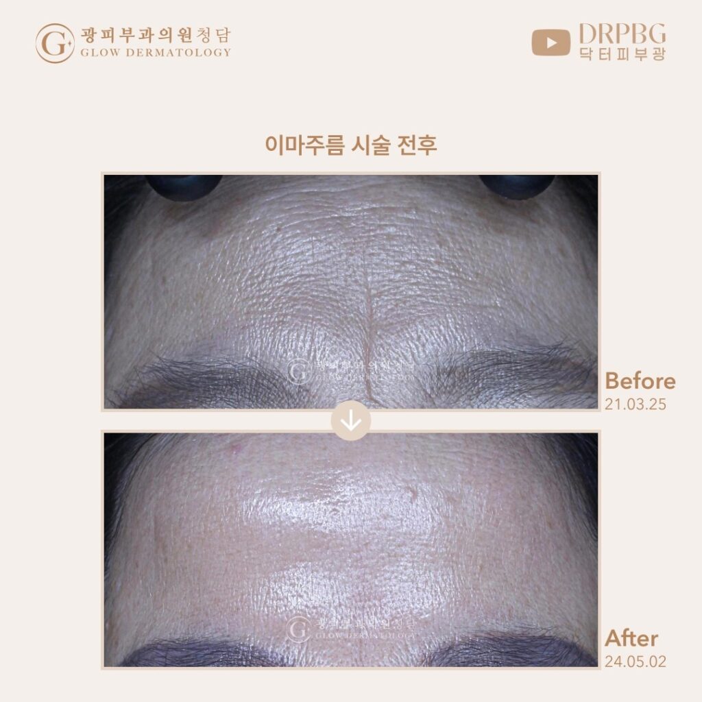 청담 광피부과청담 리프팅