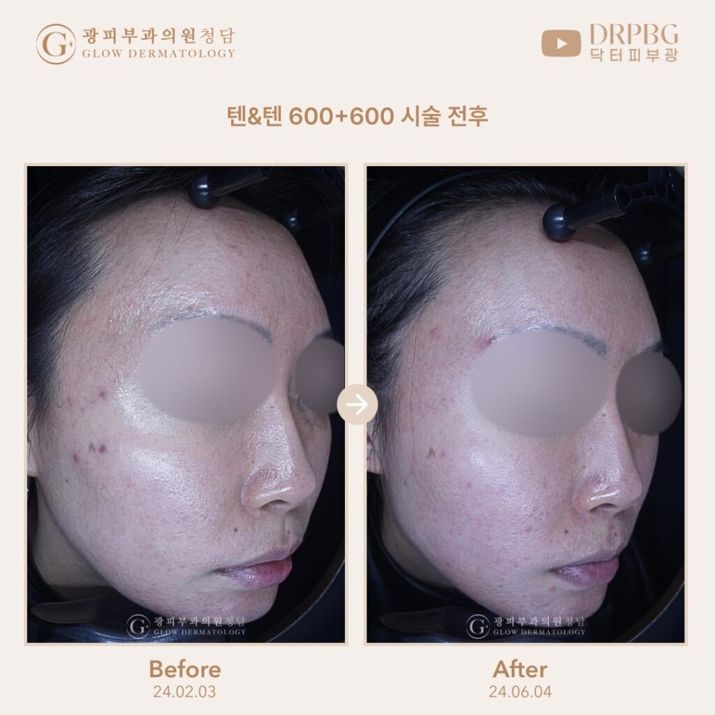 청담 광피부과청담 리프팅